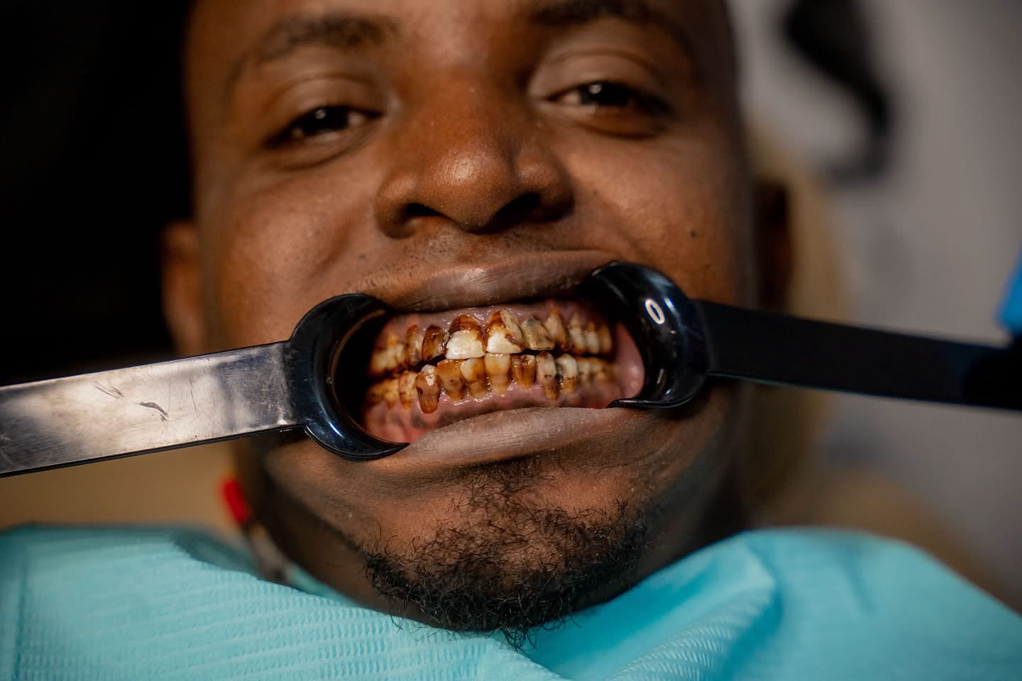 Severe Tooth Decay Before Treatment