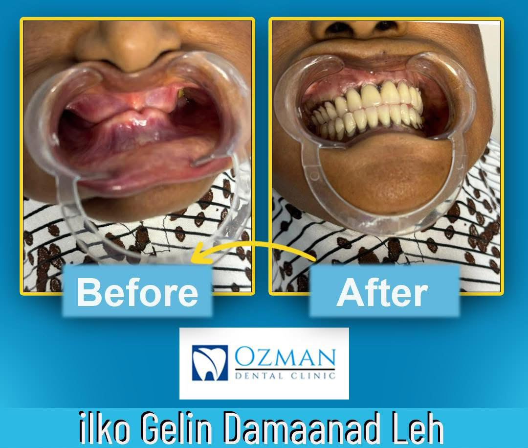 Before and After Restorative