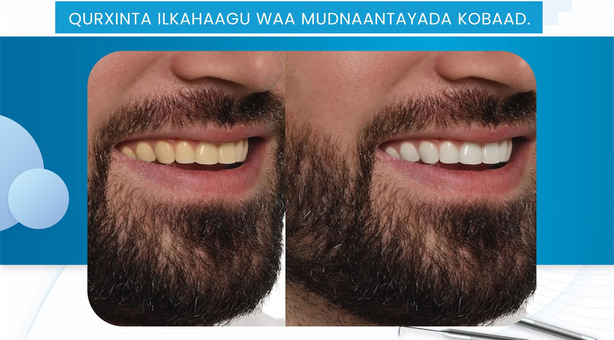 Before and After Whitening