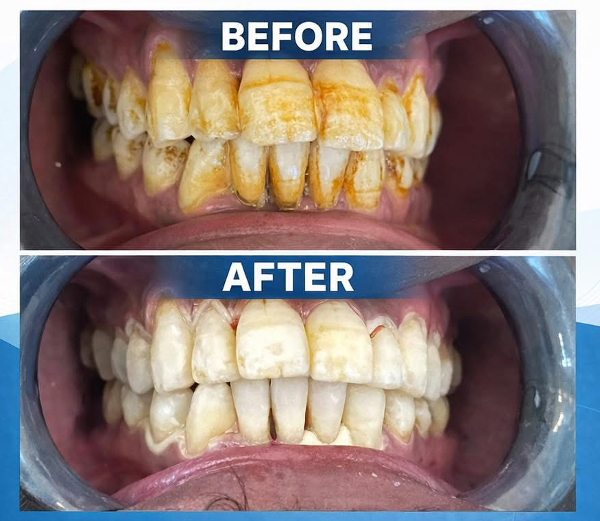 Before and After Dental Cleaning